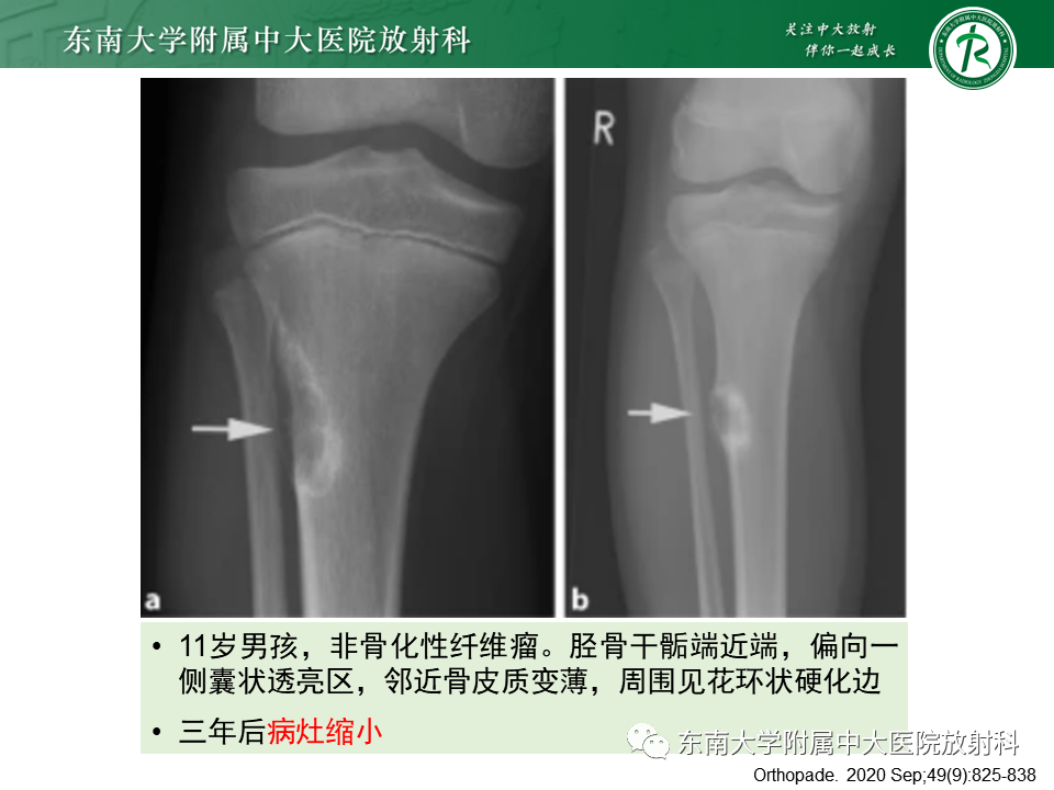【PPT】骨纤维异常增殖症-41