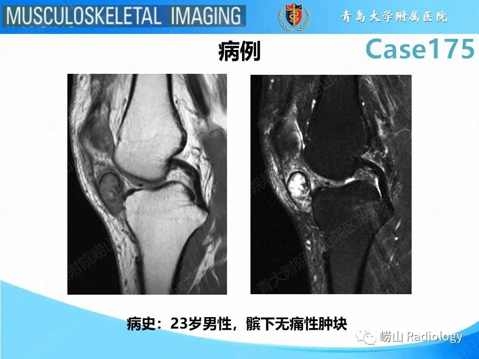 【PPT】局灶性结节性滑膜炎-2