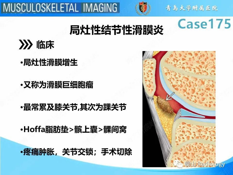 【PPT】局灶性结节性滑膜炎-11