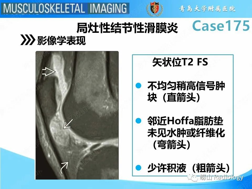 【PPT】局灶性结节性滑膜炎-13