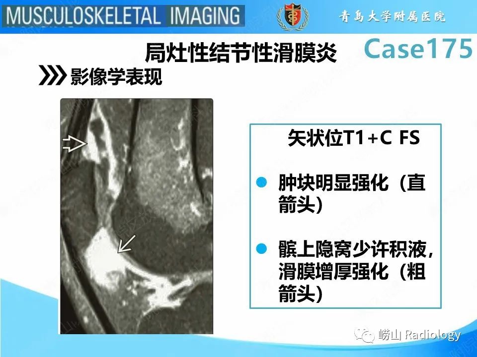 【PPT】局灶性结节性滑膜炎-14