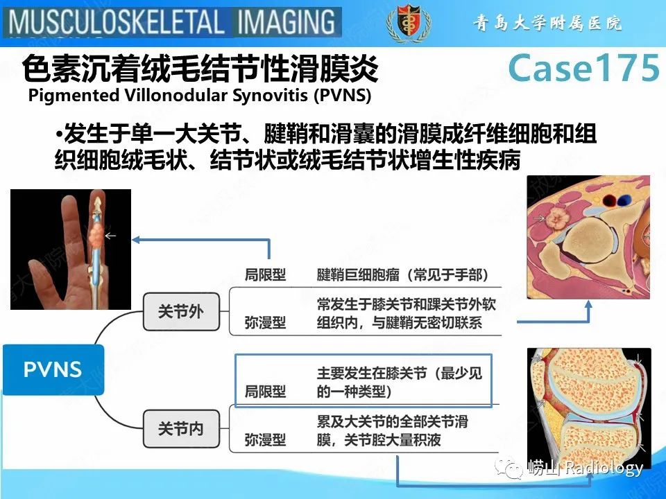 【PPT】局灶性结节性滑膜炎-15