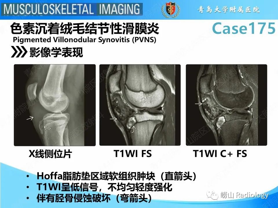 【PPT】局灶性结节性滑膜炎-16