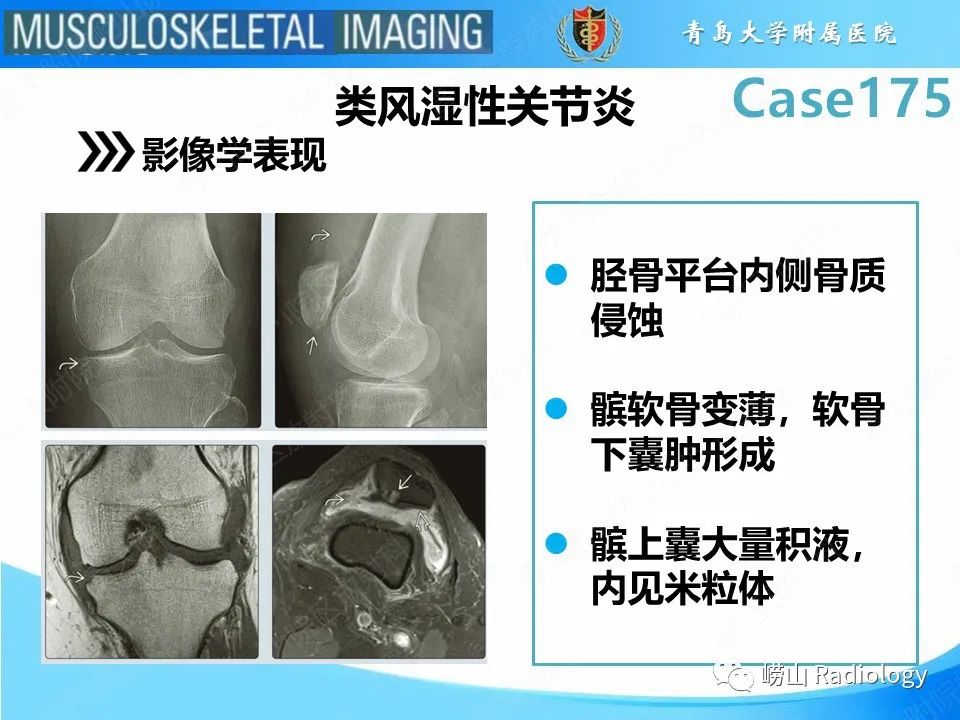 【PPT】局灶性结节性滑膜炎-18