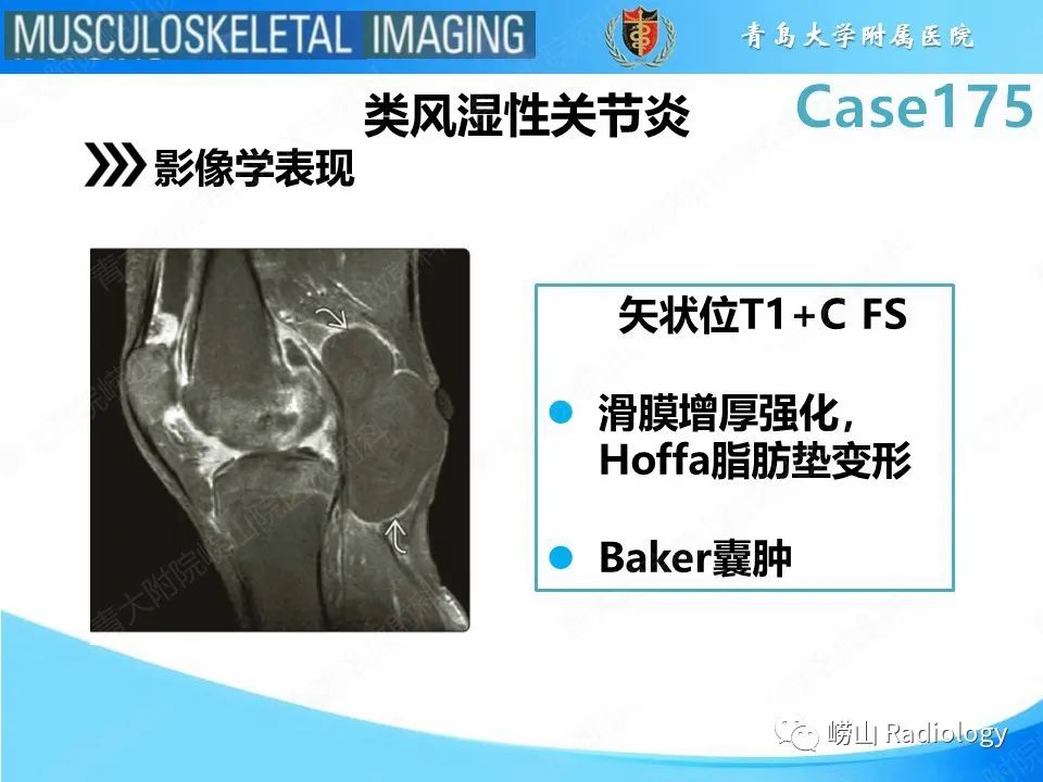 【PPT】局灶性结节性滑膜炎-19