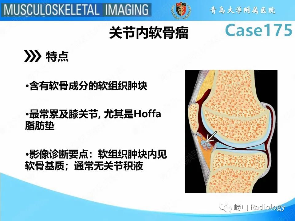【PPT】局灶性结节性滑膜炎-20