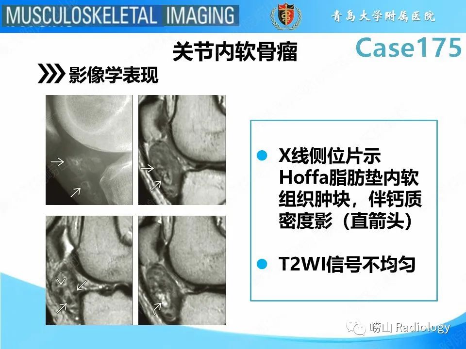 【PPT】局灶性结节性滑膜炎-21