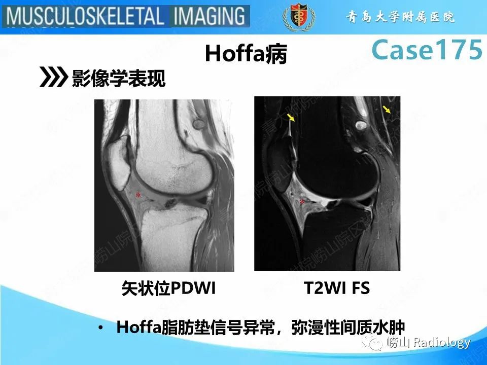 【PPT】局灶性结节性滑膜炎-23