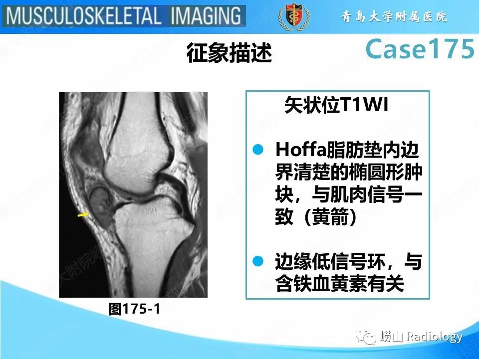 【PPT】局灶性结节性滑膜炎-25
