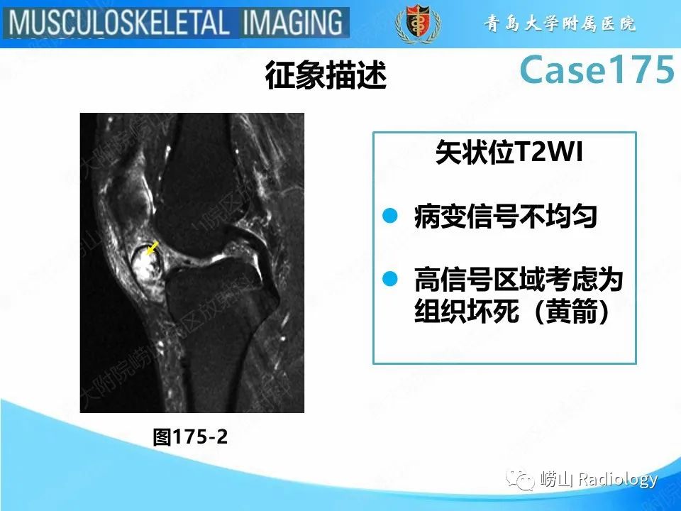 【PPT】局灶性结节性滑膜炎-26