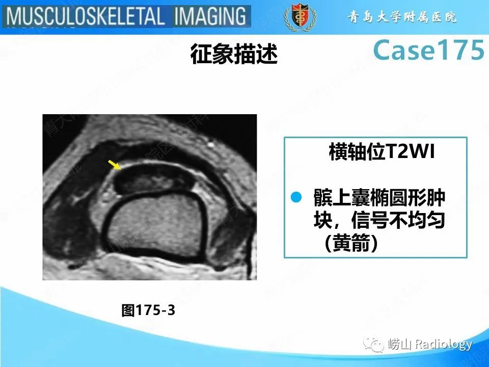 【PPT】局灶性结节性滑膜炎-27