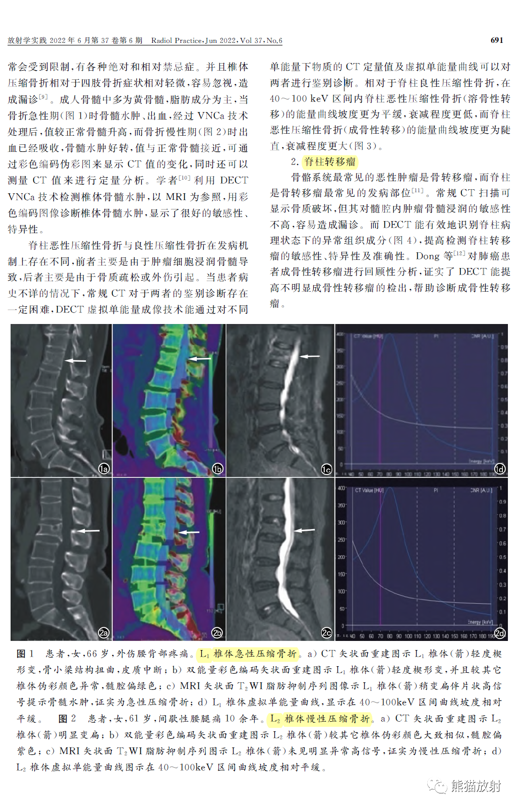 双能量CT在脊柱病变中的临床应用-2
