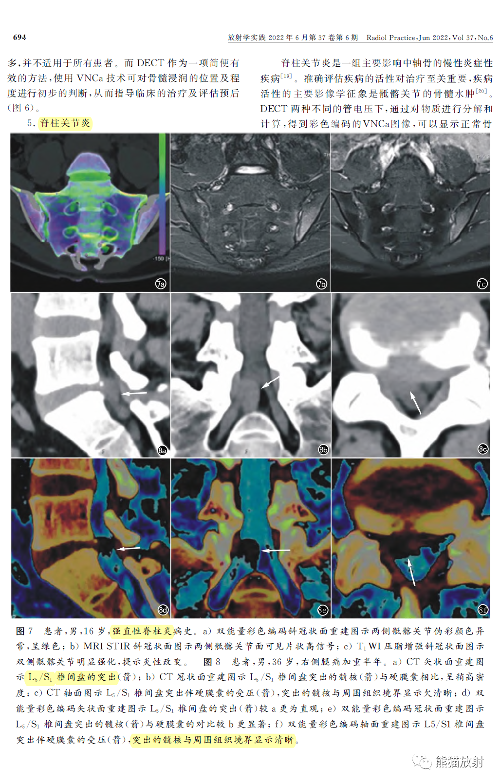 双能量CT在脊柱病变中的临床应用-5