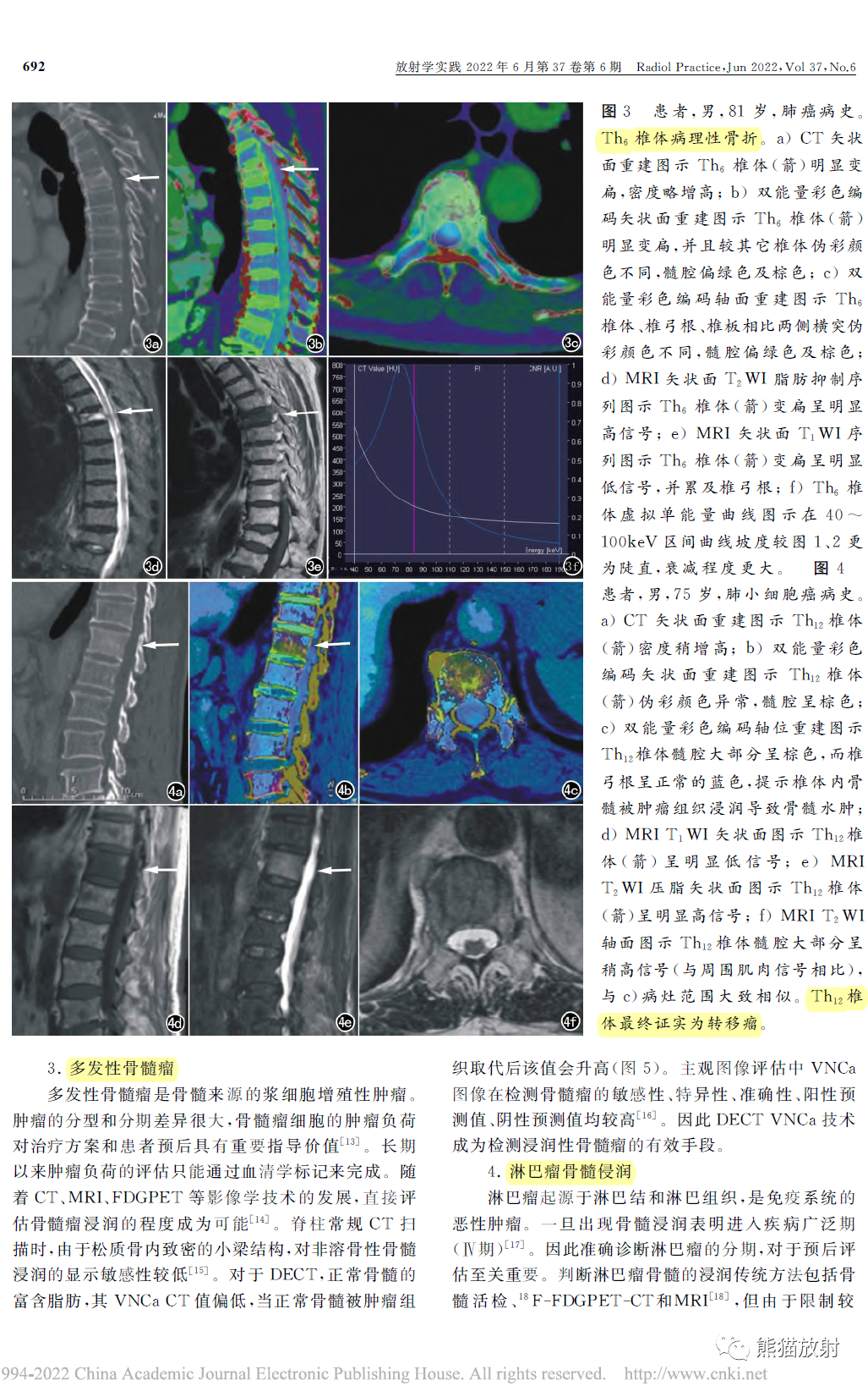 双能量CT在脊柱病变中的临床应用-3