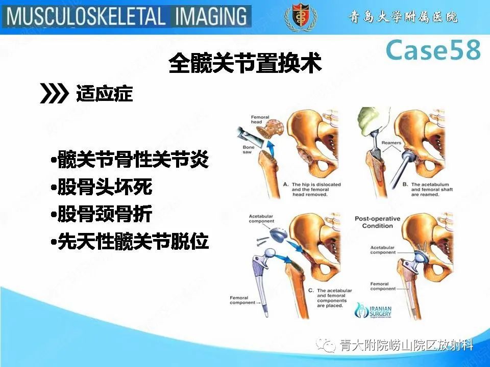 【PPT】髋关节手术并发症-5