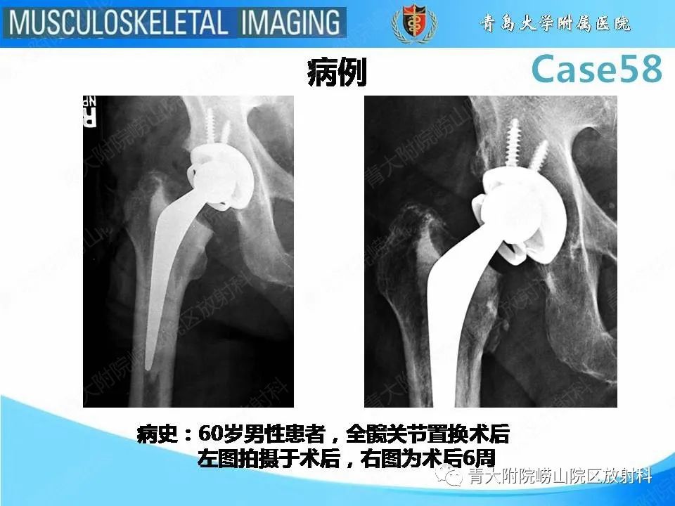 【PPT】髋关节手术并发症-2