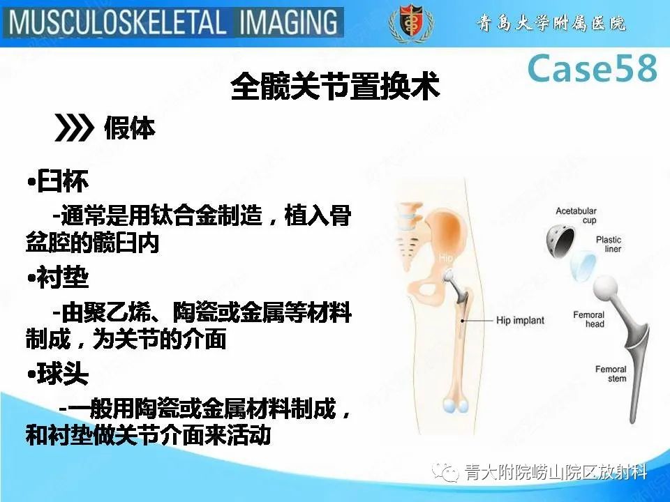 【PPT】髋关节手术并发症-6