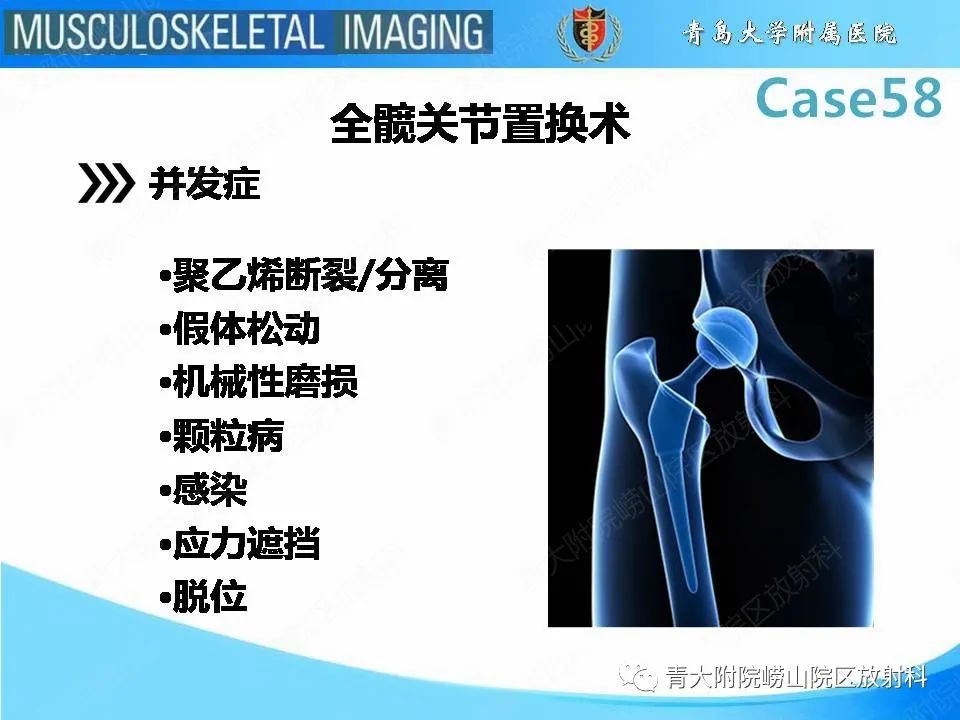 【PPT】髋关节手术并发症-8