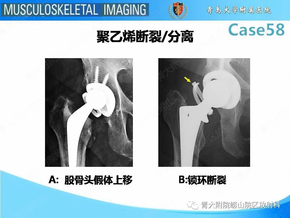 【PPT】髋关节手术并发症-10