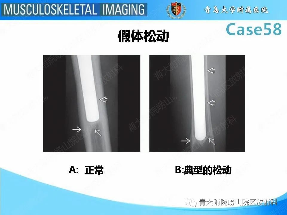 【PPT】髋关节手术并发症-12