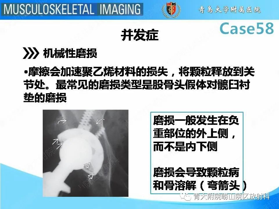 【PPT】髋关节手术并发症-13