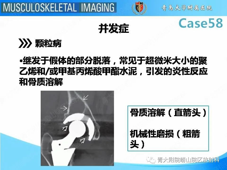 【PPT】髋关节手术并发症-14