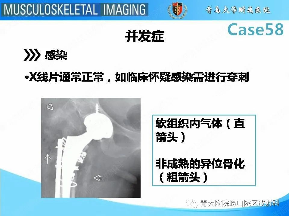 【PPT】髋关节手术并发症-15