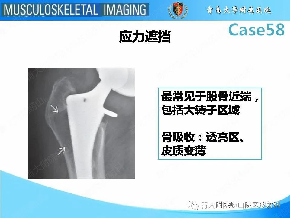 【PPT】髋关节手术并发症-17