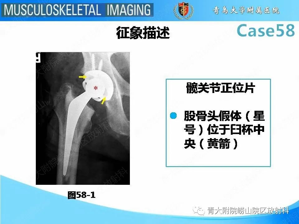 【PPT】髋关节手术并发症-24