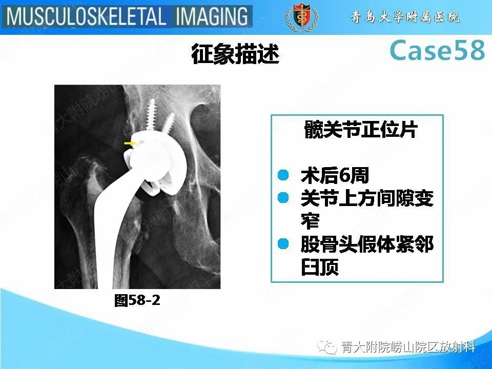 【PPT】髋关节手术并发症-25