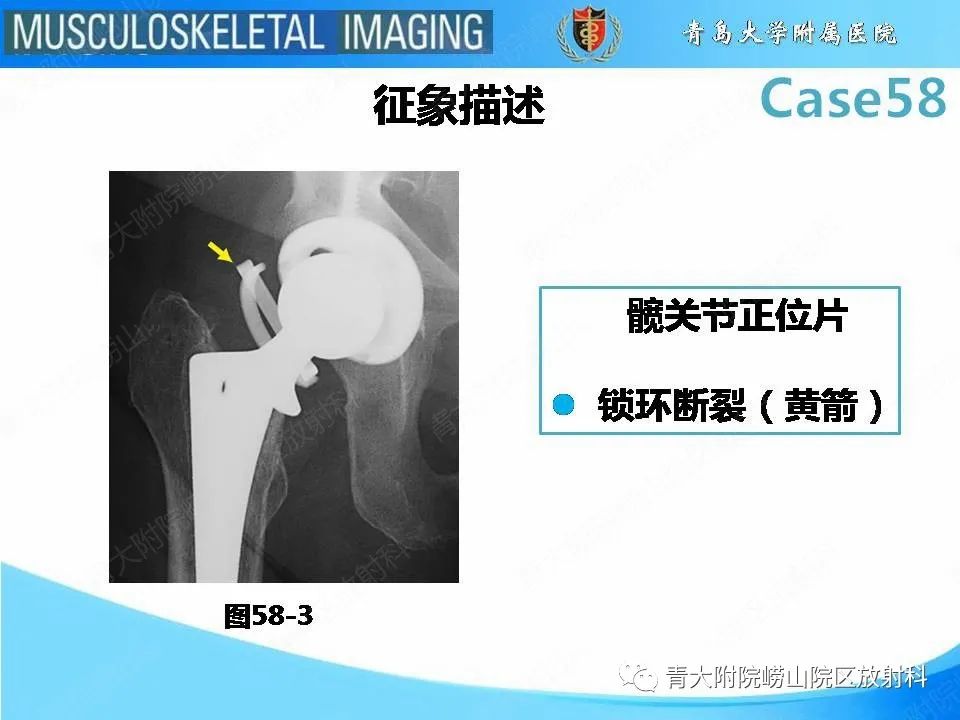 【PPT】髋关节手术并发症-26
