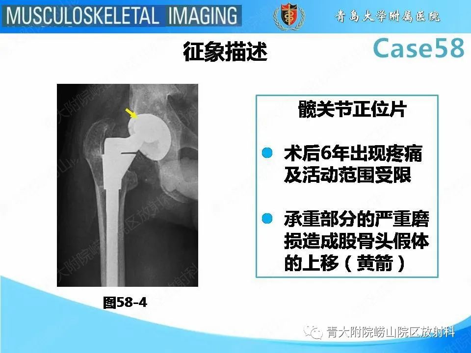 【PPT】髋关节手术并发症-27