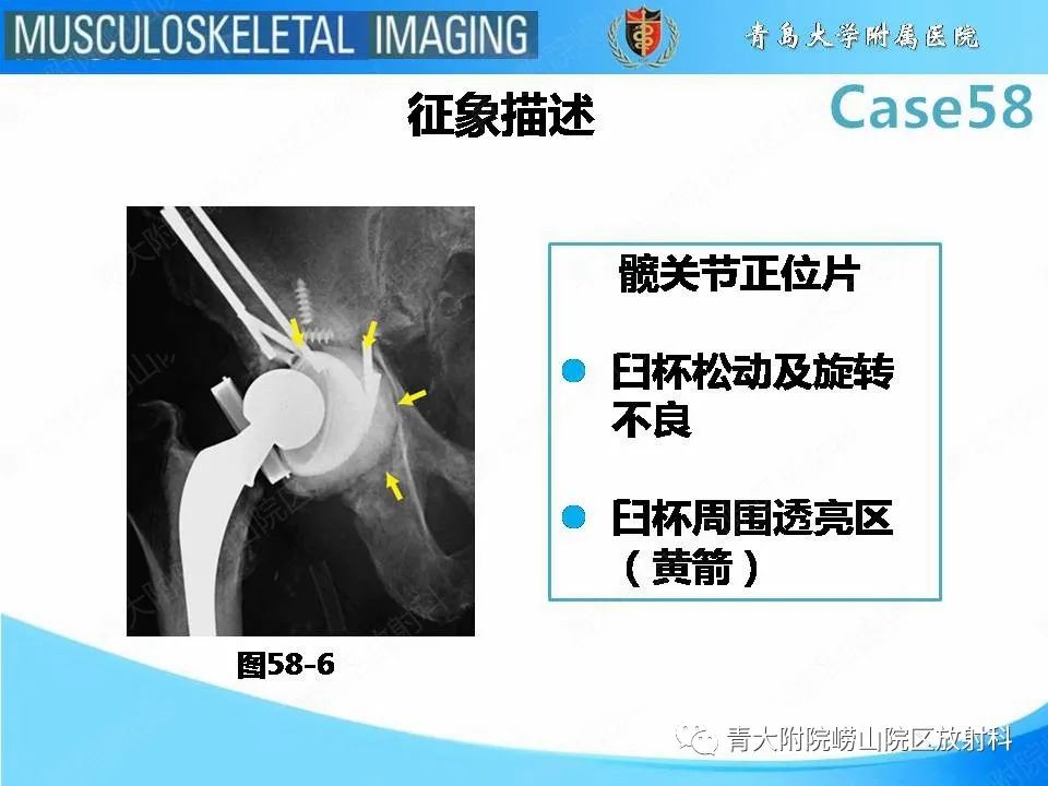 【PPT】髋关节手术并发症-29