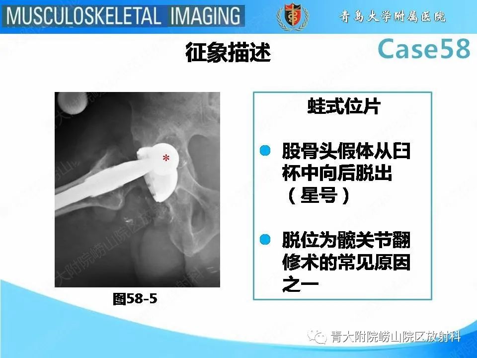 【PPT】髋关节手术并发症-28
