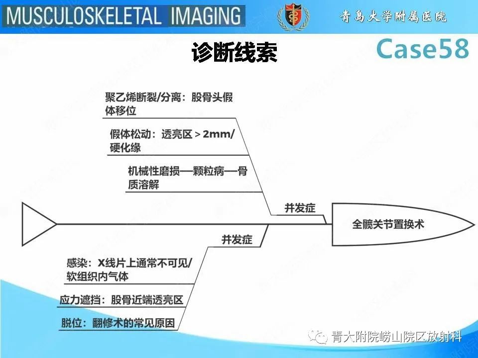 【PPT】髋关节手术并发症-30