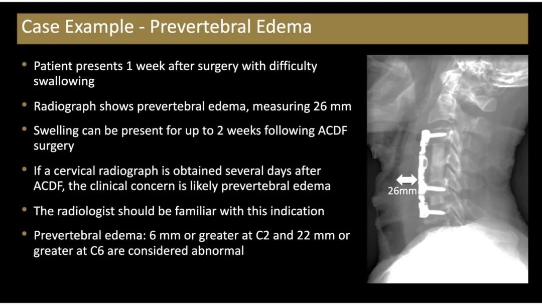 【PPT】评估围手术期脊柱:除了退行性椎间盘疾病和金属植入物的并发症外-3 【PPT】评估围手术期脊柱:除了退行性椎间盘疾病和金属植入物的并发症外-3