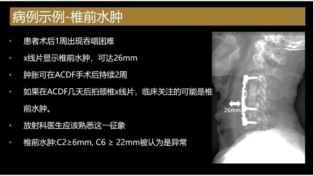 【PPT】评估围手术期脊柱:除了退行性椎间盘疾病和金属植入物的并发症外-2 【PPT】评估围手术期脊柱:除了退行性椎间盘疾病和金属植入物的并发症外-2