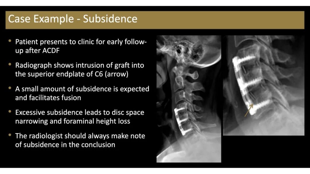 【PPT】评估围手术期脊柱:除了退行性椎间盘疾病和金属植入物的并发症外-5 【PPT】评估围手术期脊柱:除了退行性椎间盘疾病和金属植入物的并发症外-5