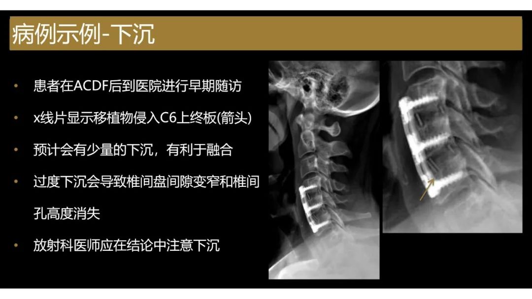【PPT】评估围手术期脊柱:除了退行性椎间盘疾病和金属植入物的并发症外-4 【PPT】评估围手术期脊柱:除了退行性椎间盘疾病和金属植入物的并发症外-4