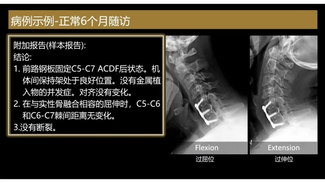 【PPT】评估围手术期脊柱:除了退行性椎间盘疾病和金属植入物的并发症外-8 【PPT】评估围手术期脊柱:除了退行性椎间盘疾病和金属植入物的并发症外-8