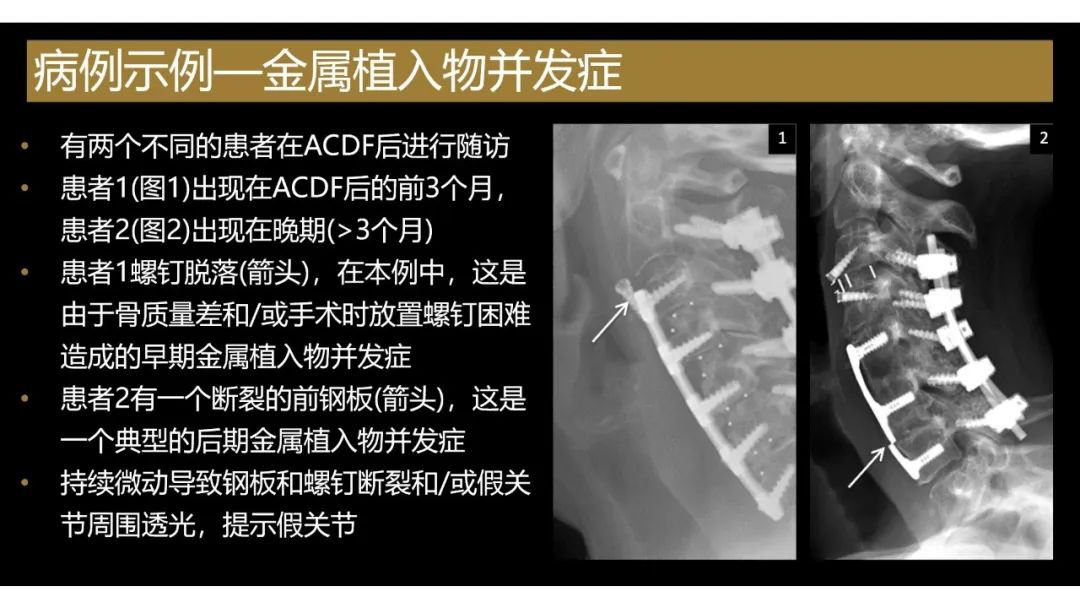 【PPT】评估围手术期脊柱:除了退行性椎间盘疾病和金属植入物的并发症外-10 【PPT】评估围手术期脊柱:除了退行性椎间盘疾病和金属植入物的并发症外-10