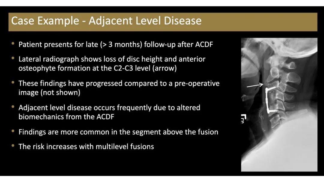 【PPT】评估围手术期脊柱:除了退行性椎间盘疾病和金属植入物的并发症外-13 【PPT】评估围手术期脊柱:除了退行性椎间盘疾病和金属植入物的并发症外-13
