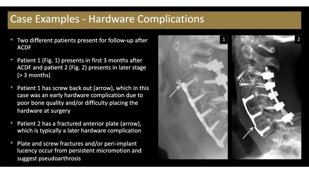 【PPT】评估围手术期脊柱:除了退行性椎间盘疾病和金属植入物的并发症外-11 【PPT】评估围手术期脊柱:除了退行性椎间盘疾病和金属植入物的并发症外-11