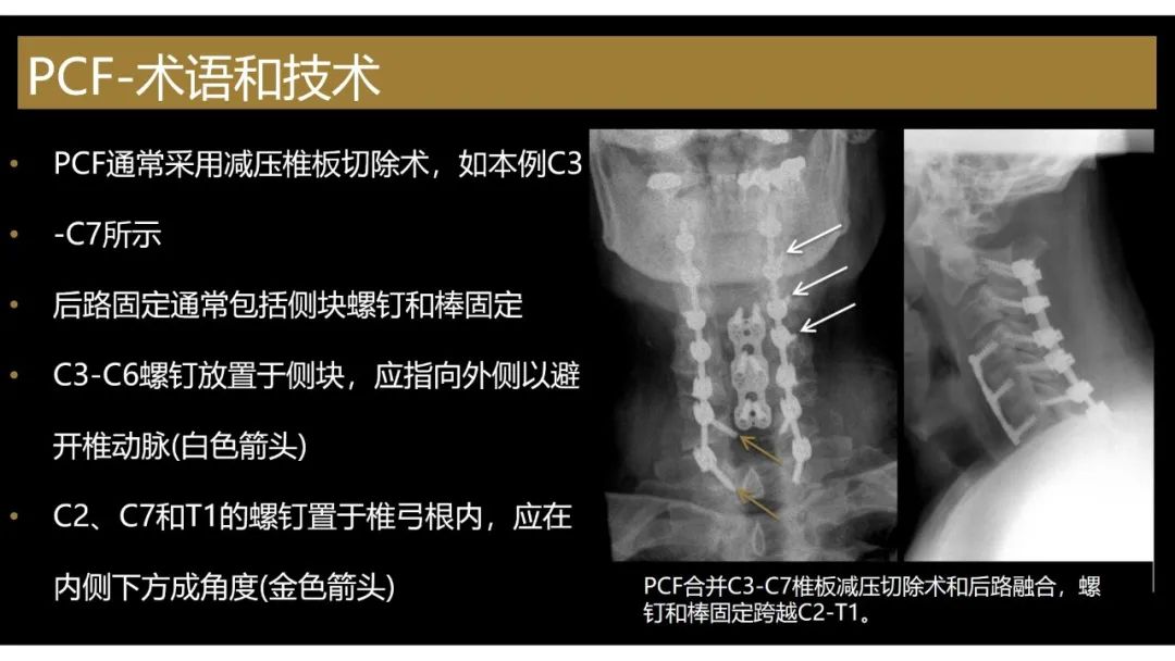 【PPT】评估围手术期脊柱:除了退行性椎间盘疾病和金属植入物的并发症外-16 【PPT】评估围手术期脊柱:除了退行性椎间盘疾病和金属植入物的并发症外-16