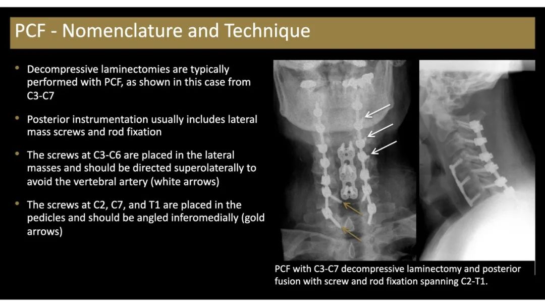 【PPT】评估围手术期脊柱:除了退行性椎间盘疾病和金属植入物的并发症外-17 【PPT】评估围手术期脊柱:除了退行性椎间盘疾病和金属植入物的并发症外-17