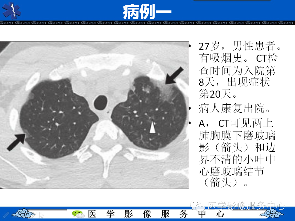 中东呼吸综合征的影像学表现