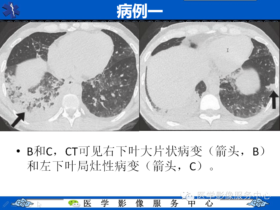中东呼吸综合征的影像学表现