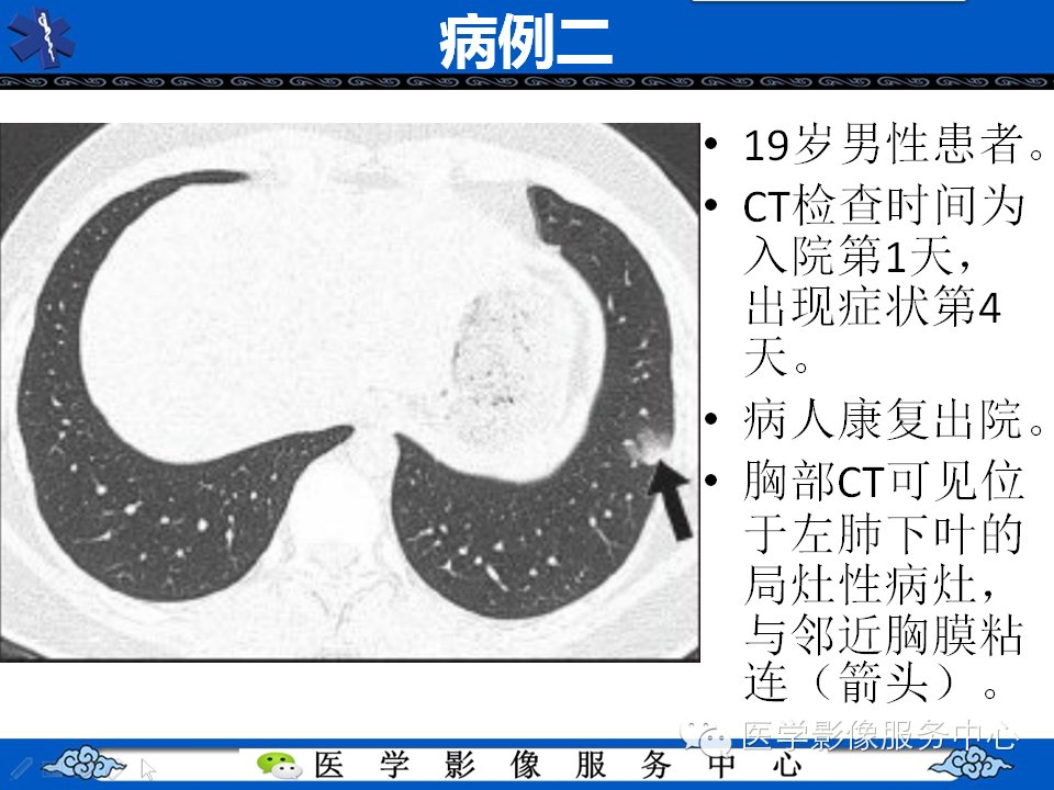 中东呼吸综合征的影像学表现