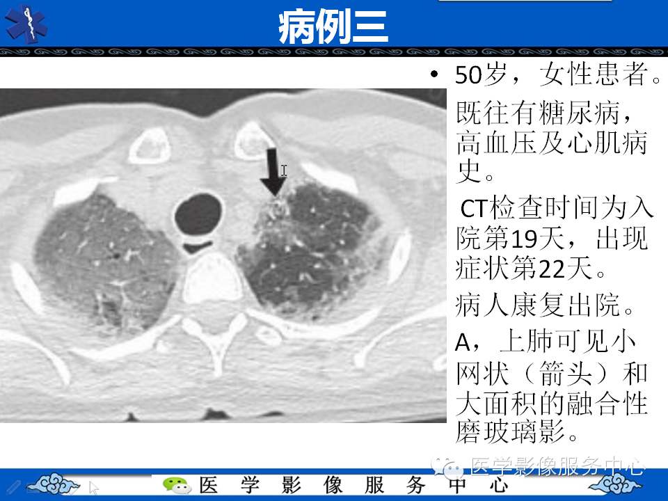 中东呼吸综合征的影像学表现