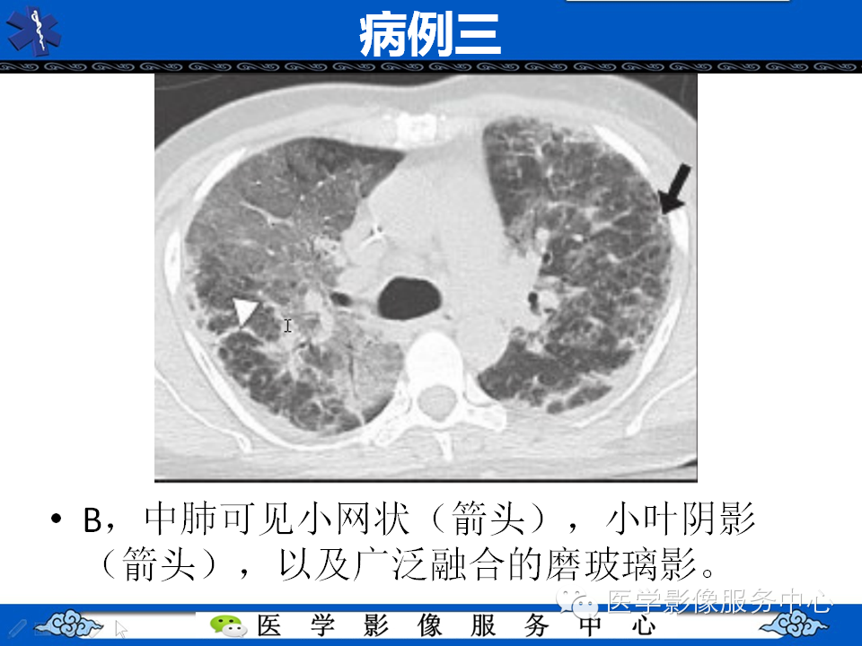 中东呼吸综合征的影像学表现